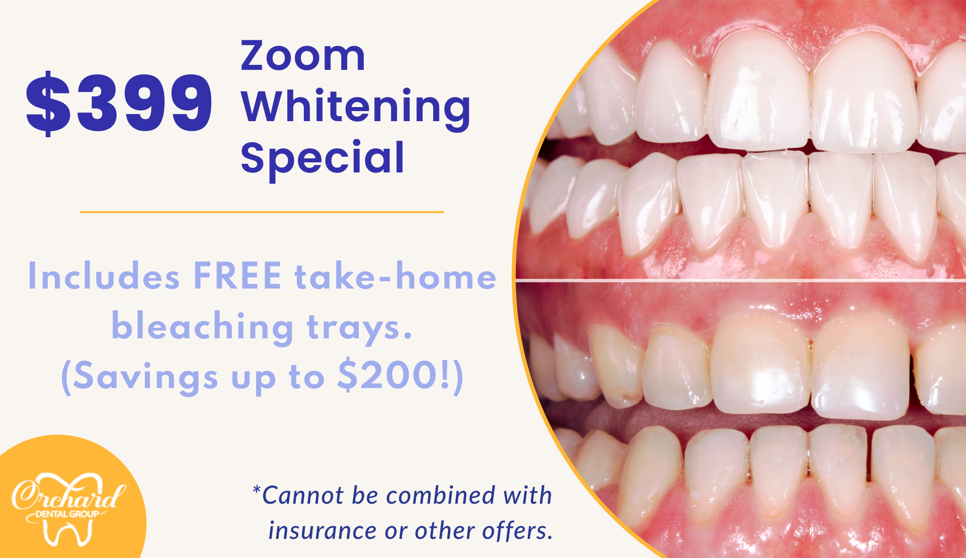 Zoom Teeth Whiteneing special in Corona, CA